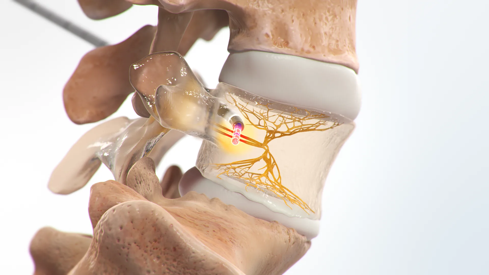 Boston Scientific Intracept — lateral view of the spine highlighting the basivertebral nerve.