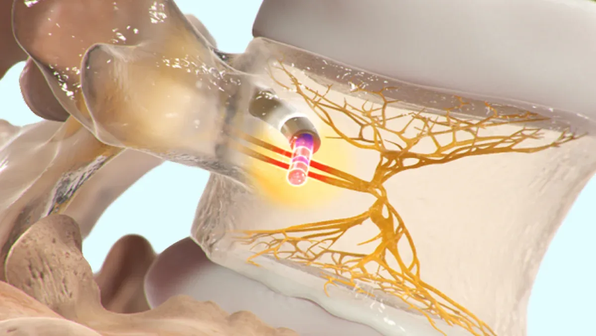 Illustration of the Intracept procedure: the probe reaching the basivertebral nerve within the vertebral body, with the ablation target highlighted.