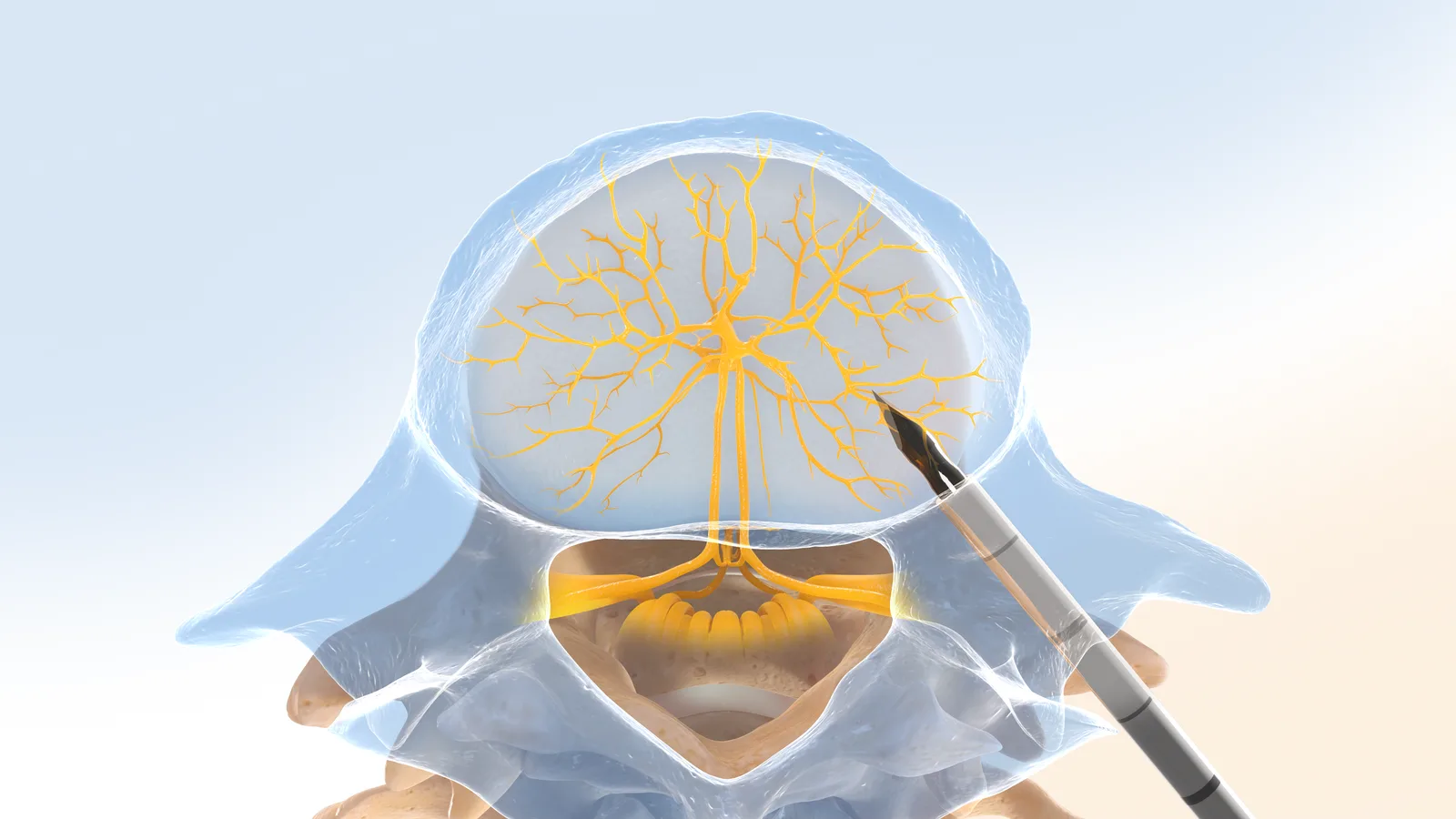 Intracept procedure step 1: the introducer cannula advanced through the pedicle toward the basivertebral nerve, under fluoroscopic guidance.