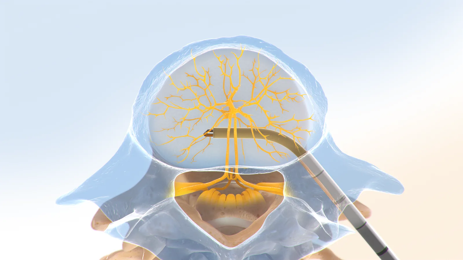 Intracept procedure step 2: the curved cannula creating a channel toward the trunk of the basivertebral nerve.