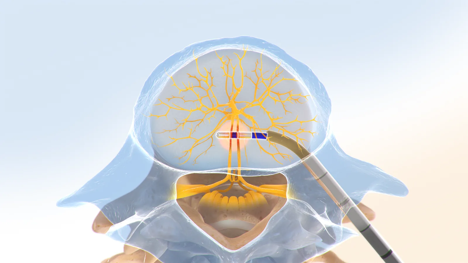 Intracept procedure step 4: the RF generator delivers radiofrequency energy that ablates the basivertebral nerve.