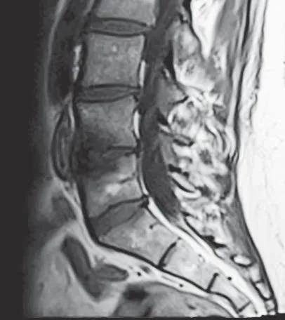 De-identified sagittal lumbar MRI (T1-weighted) showing Modic Type 1 endplate changes, which often appear darker (hypointense) on T1.