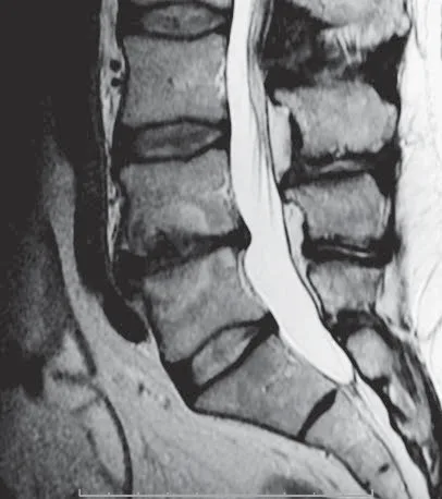 De-identified sagittal lumbar MRI (T2-weighted) showing Modic Type 1 endplate changes, which often appear brighter (hyperintense) on T2.