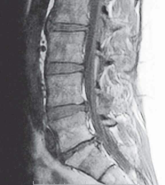 De-identified sagittal lumbar MRI (T1-weighted) showing Modic Type 2 endplate changes, which often appear brighter (hyperintense) on T1.