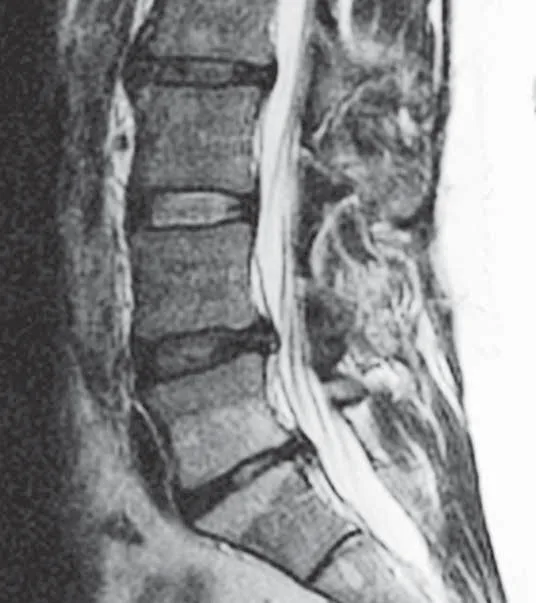 De-identified sagittal lumbar MRI (T2-weighted) showing Modic Type 2 endplate changes, which often appear brighter (hyperintense) on T2.