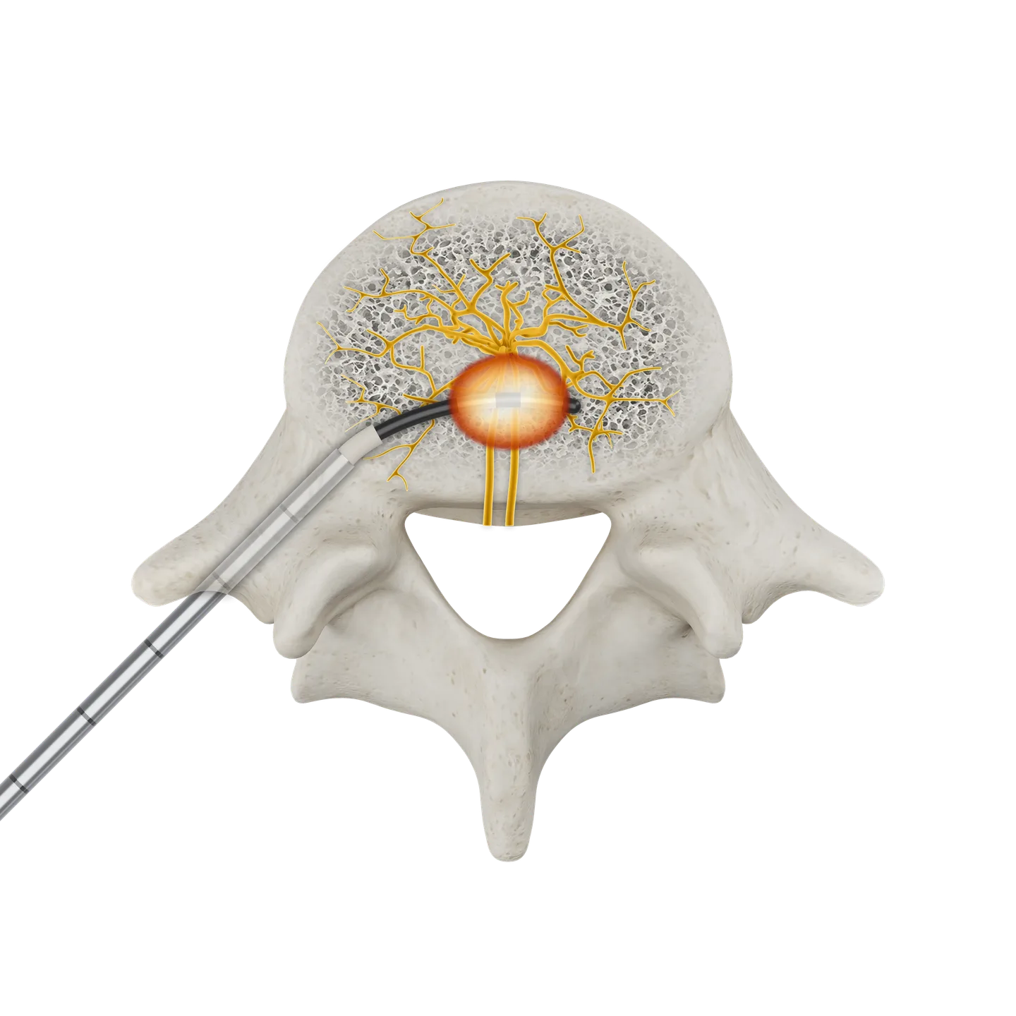 Axial (cross-sectional) illustration of a vertebral body showing the ablation lesion at the basivertebral nerve (Stryker OptaBlate BVN System).