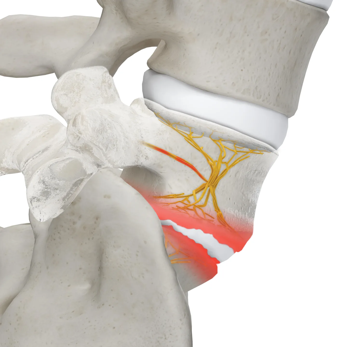Illustration of damaged vertebral endplates before treatment (Stryker OptaBlate BVN System).