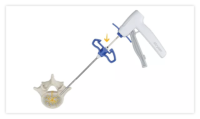 OptaBlate procedure highlight 2: the introducer with conduit inserted into the access cannula.