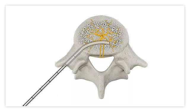 OptaBlate procedure highlight 3: the introducer and conduit advanced across the spinous process toward the basivertebral nerve.