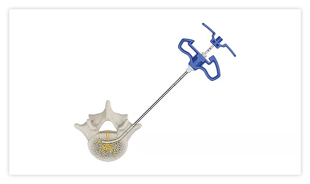 OptaBlate procedure highlight 4: the introducer removed, leaving the conduit in place within the vertebral body.