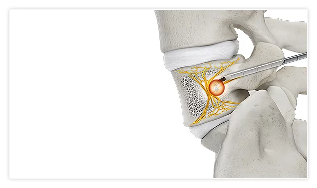 OptaBlate procedure highlight 6: radiofrequency ablation delivered at the basivertebral nerve, with saline flow active.