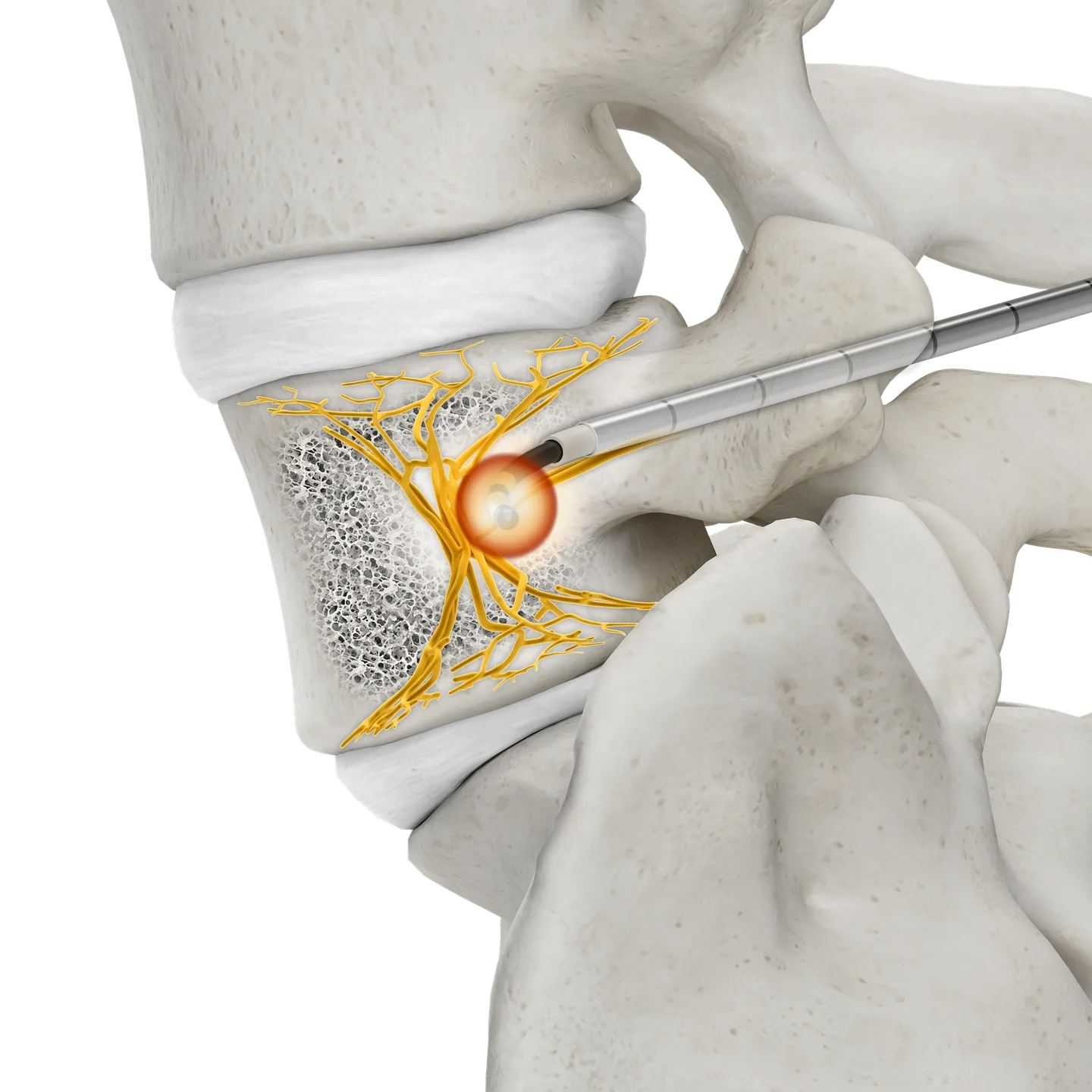 Lateral (side) view of a vertebral body showing the ablation lesion at the basivertebral nerve (Stryker OptaBlate BVN System).