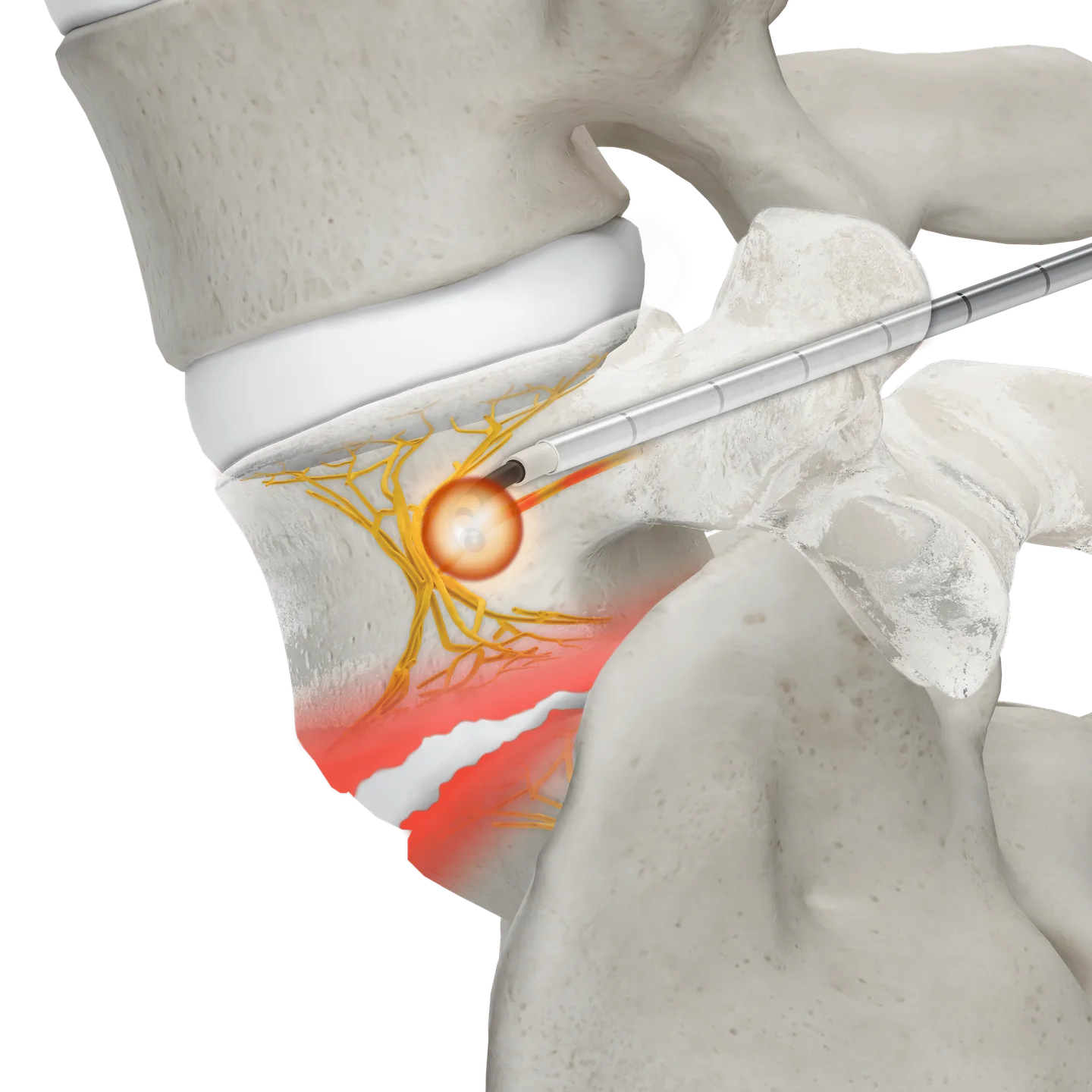 Illustration of damaged vertebral endplates with the ablation probe placed toward the basivertebral nerve (Stryker OptaBlate BVN System).