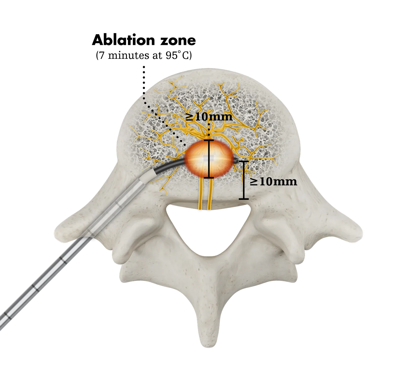 Illustration of the ablation safe zone for the basivertebral nerve (Stryker OptaBlate BVN System).